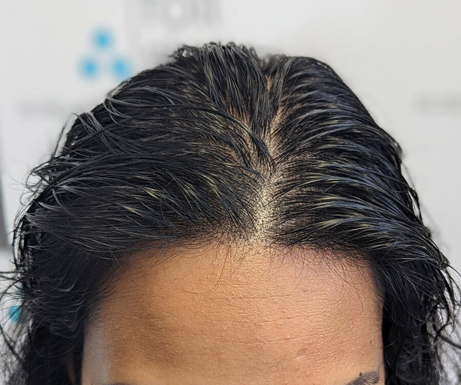 after-scalp-micro-pigmentation-women