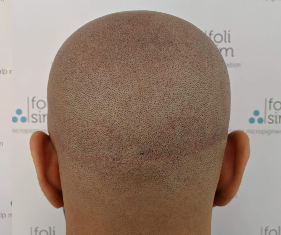after-scalp-micropigmentation-for-scar