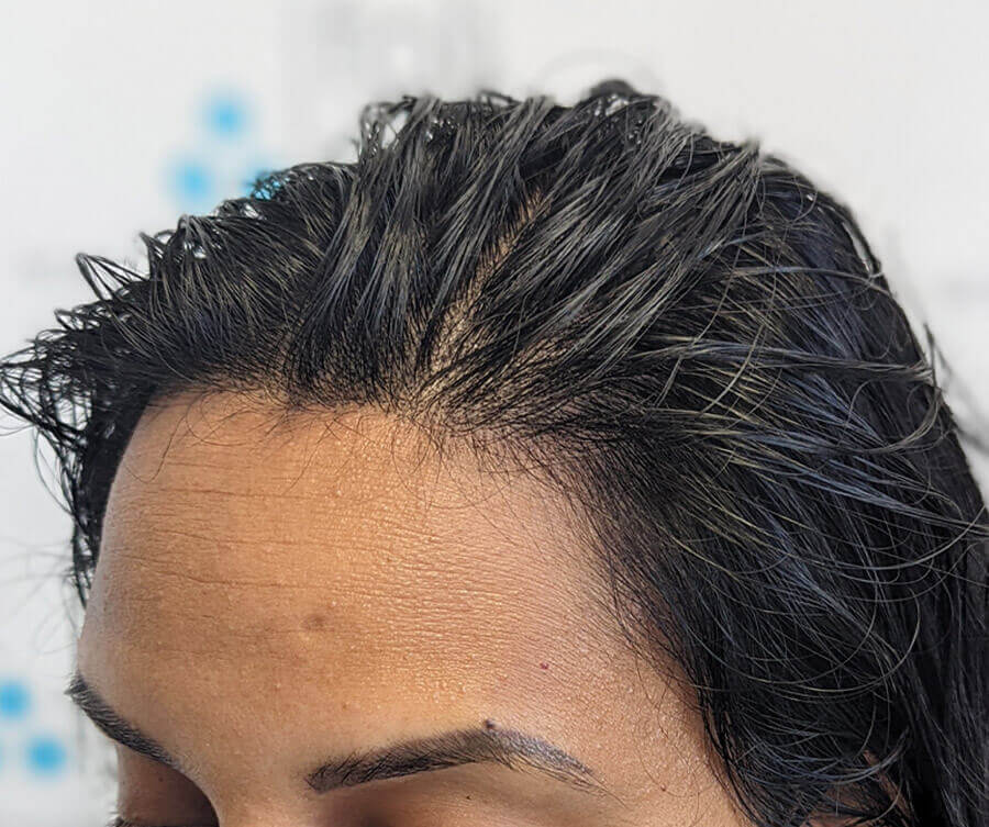 after-scalp-micropigmentation-women