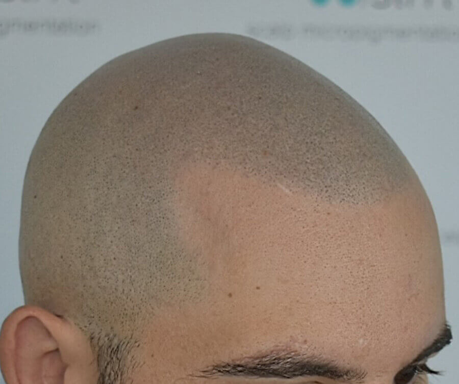 after-scalp-micropigmentation
