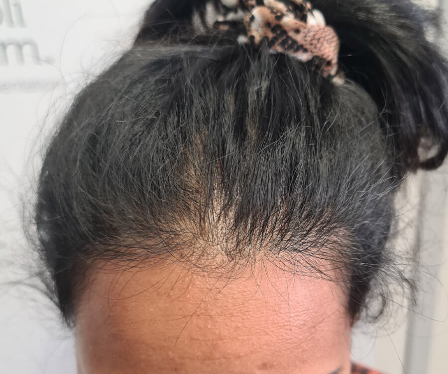 before-scalp-micro-pigmentation-women