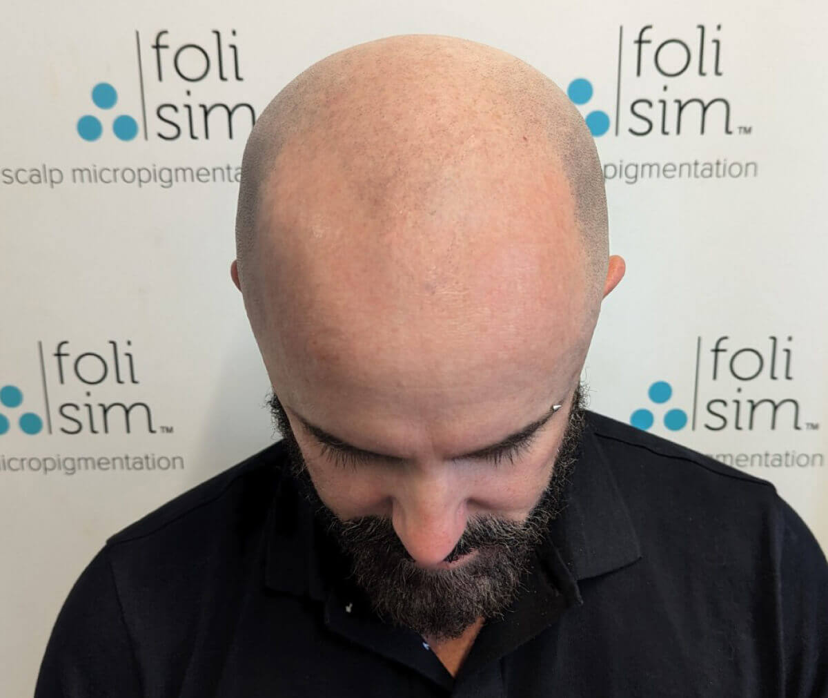 before-scalp-micropigmentation-buzz-cut