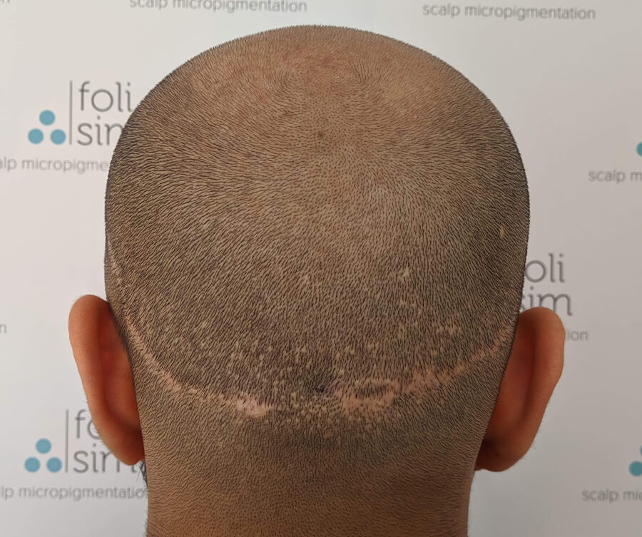 before-scalp-micropigmentation-for-scar (1)