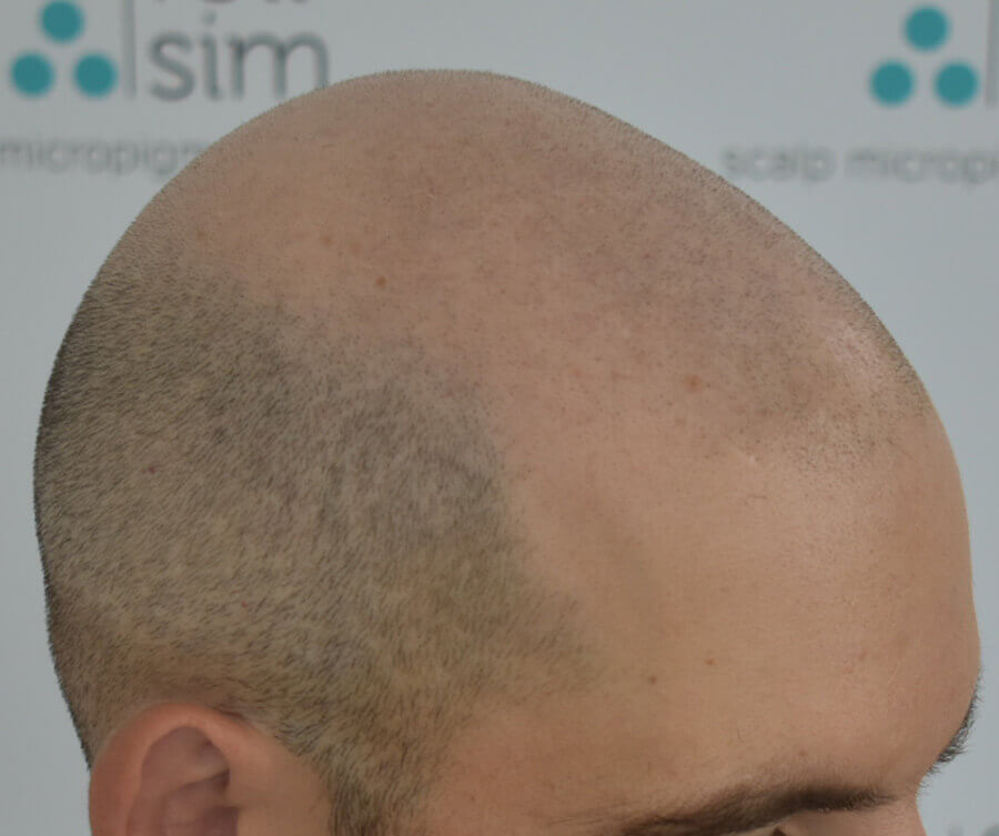 before-scalp-micropigmentation-women