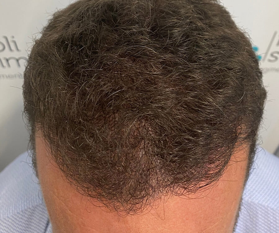 scalp-micropigmentation-after (2)