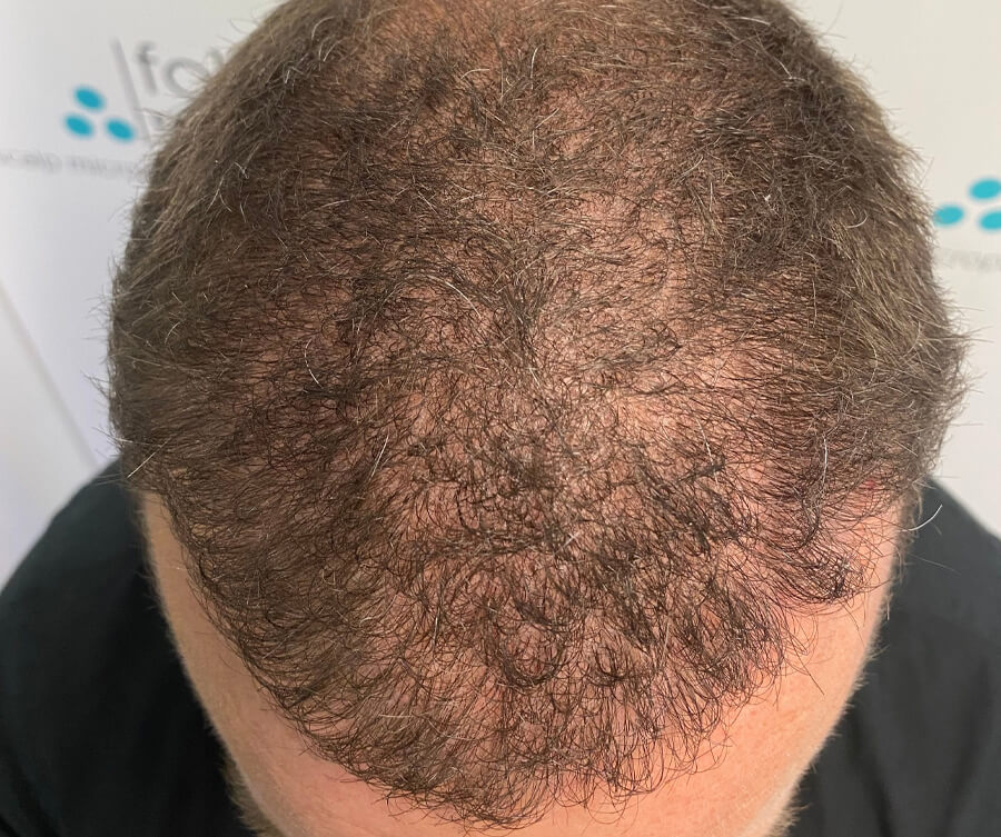 scalp-micropigmentation-before (1)