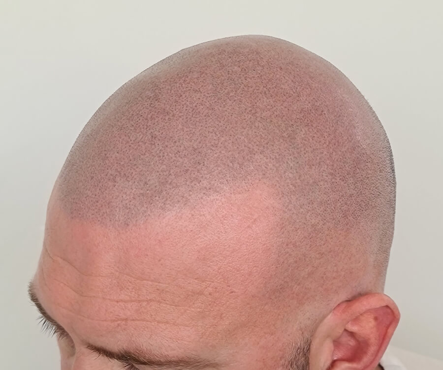 scalp-micropigmentation-for-buzz-cut-after