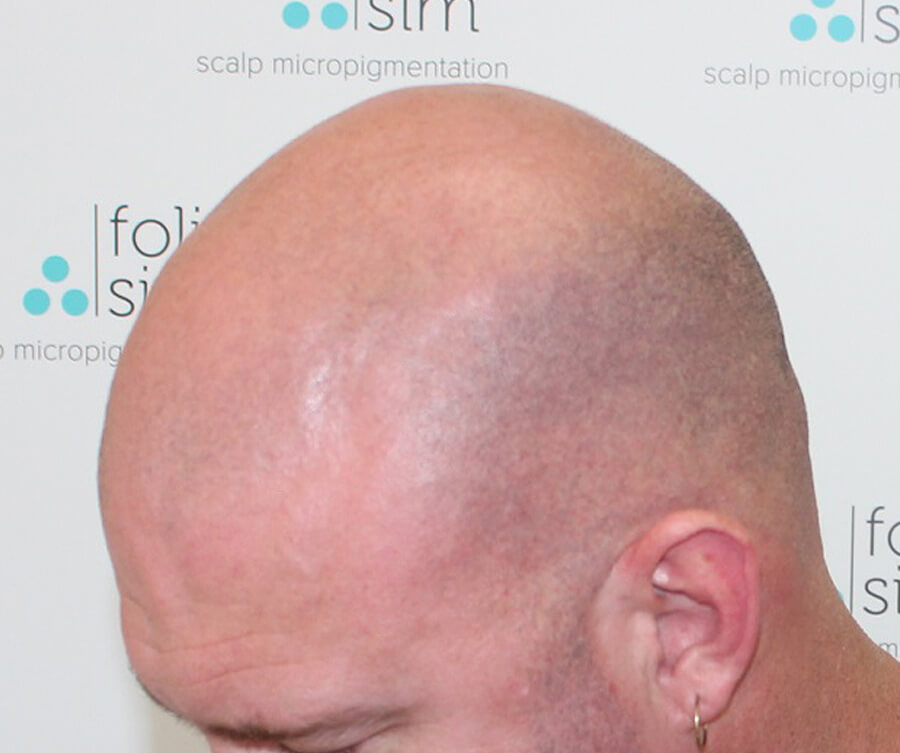 scalp-micropigmentation-for-buzz-cut-before
