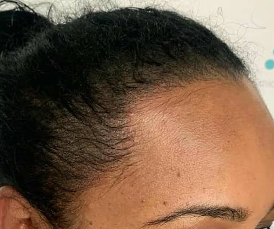 scalp-micropigmentation-women-after