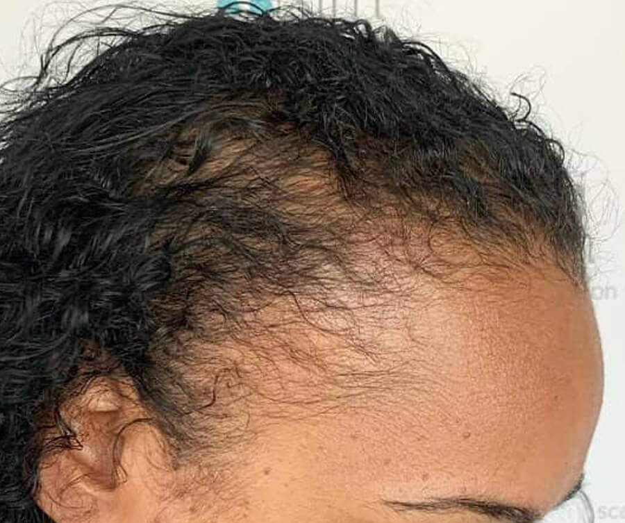 scalp-micropigmentation-women-before
